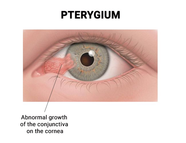 Pterygium Eye Condition