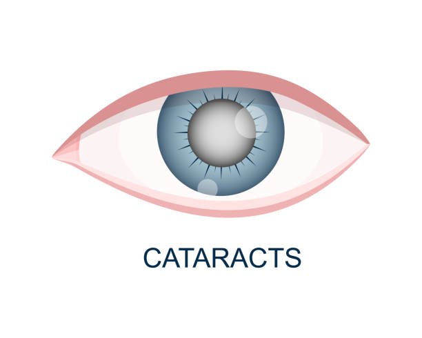 Cataract Eye