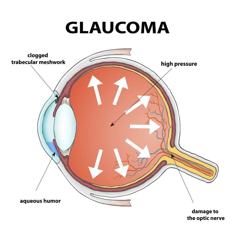 Glaucoma Awareness