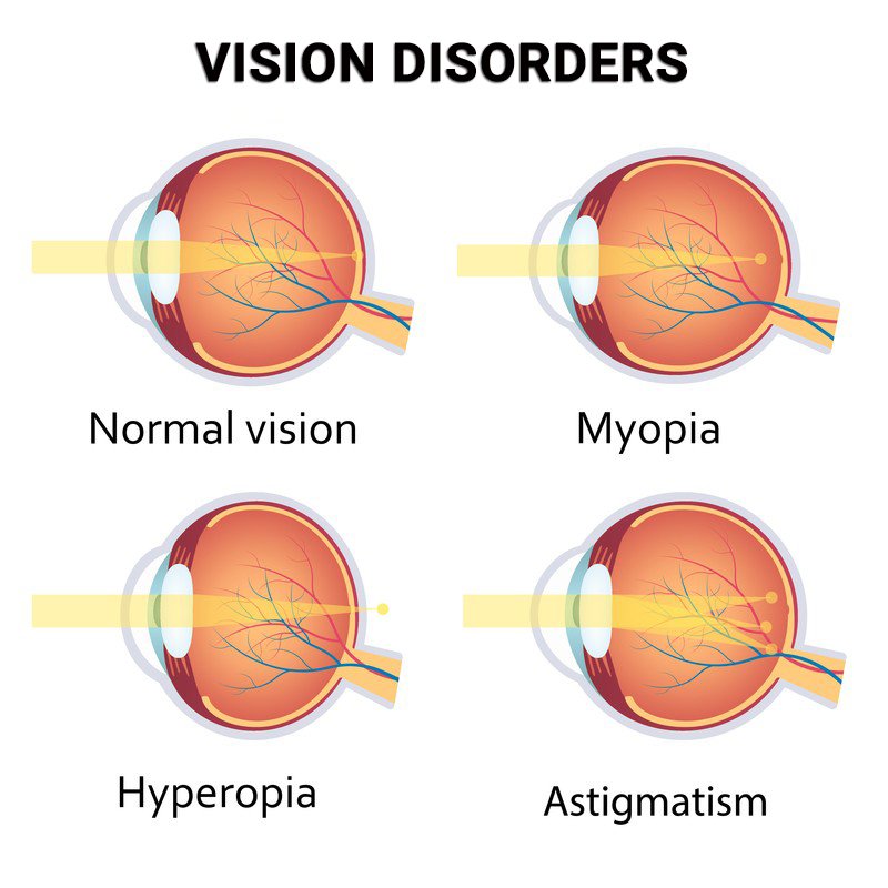 Refractive Vision Errors